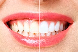 Factors that affect the cost of teeth whitening include the type and severity of the stains present