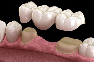 Digital illustration of a dental bridge