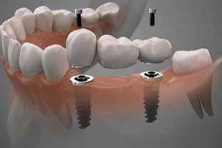 Digital illustration of an implant bridge