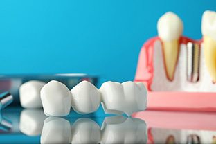 Sample dental bridge in front of sample implant on reflective surface with light blue background